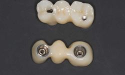 implantes dentales viña del mar