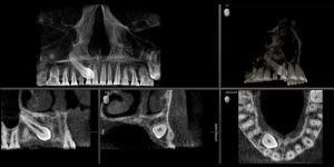 escaner-óseo-TA-radiografía-dental